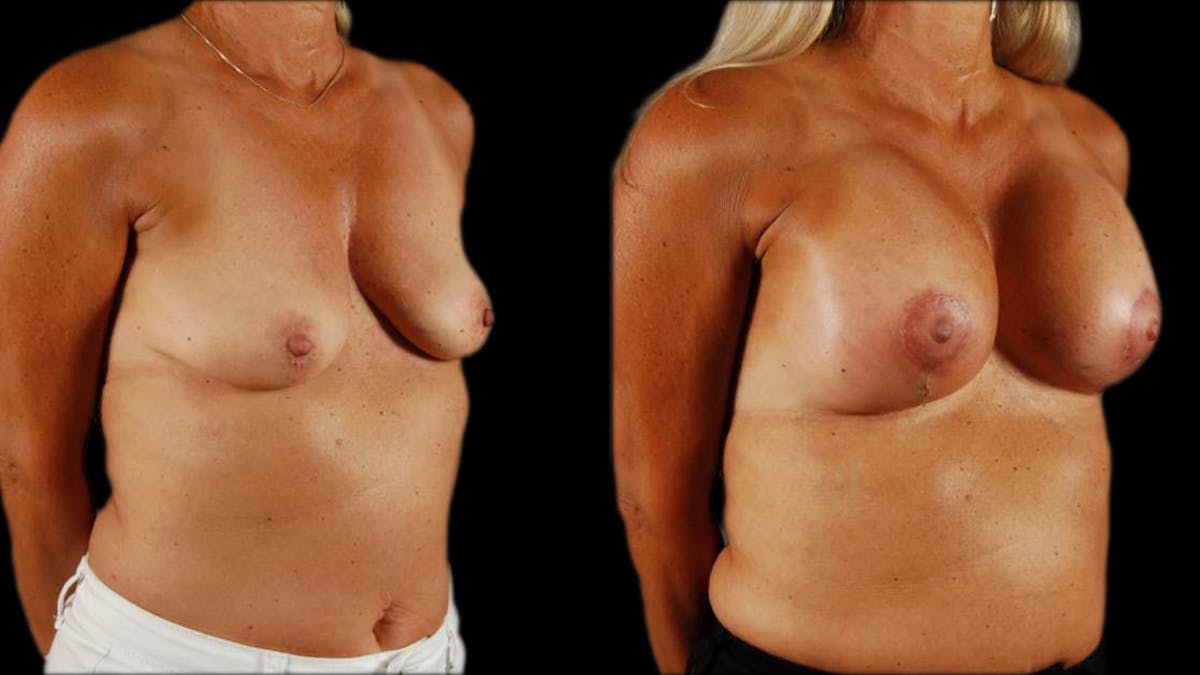 Breast Lift with Implants Before & After Gallery - Patient 999078 - Image 4