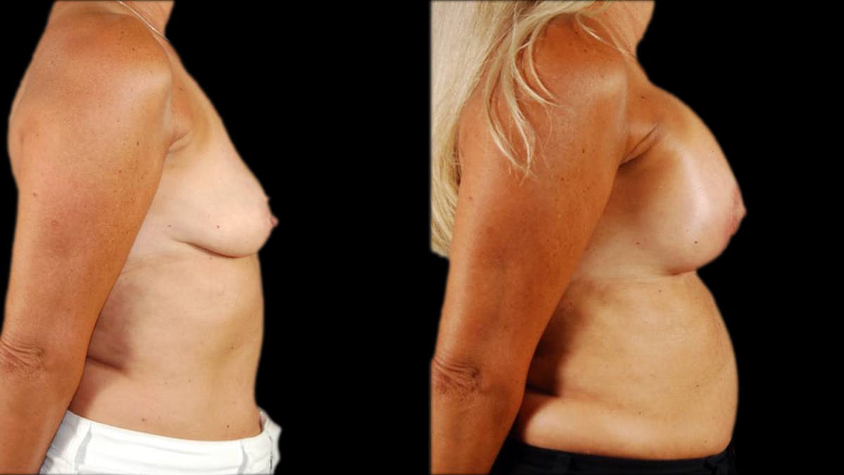 Breast Lift with Implants Before & After Gallery - Patient 999078 - Image 5