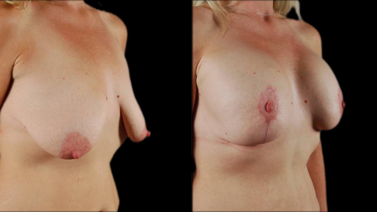 Breast Lift with Implants Before & After Gallery - Patient 319676 - Image 4