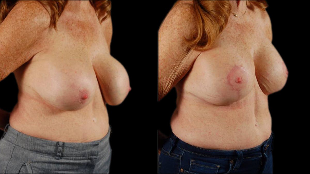 Breast Lift with Implants Before & After Gallery - Patient 157932 - Image 2