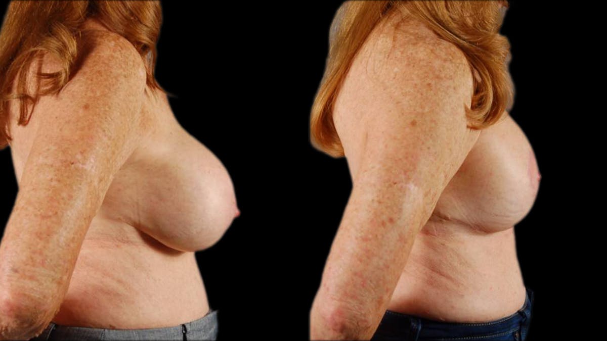 Breast Lift with Implants Before & After Gallery - Patient 157932 - Image 3