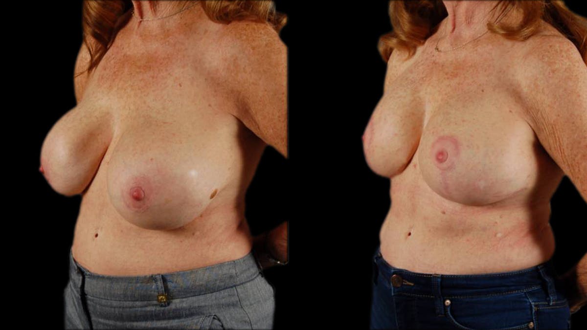 Breast Lift with Implants Before & After Gallery - Patient 157932 - Image 4