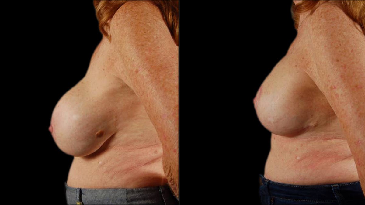 Breast Lift with Implants Before & After Gallery - Patient 157932 - Image 5
