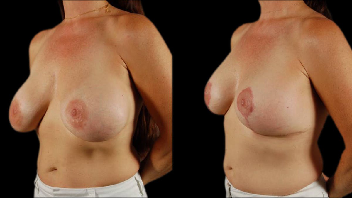 Breast Lift with Implants Before & After Gallery - Patient 492766 - Image 2