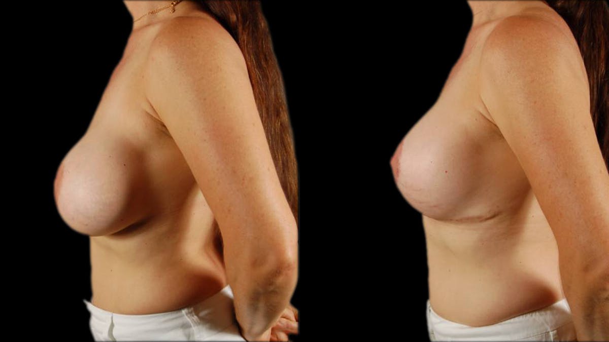 Breast Lift with Implants Before & After Gallery - Patient 492766 - Image 3