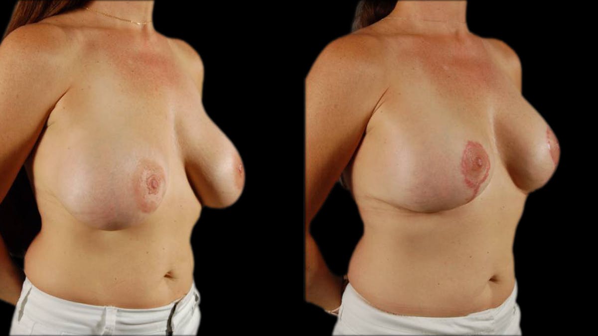 Breast Lift with Implants Before & After Gallery - Patient 492766 - Image 4