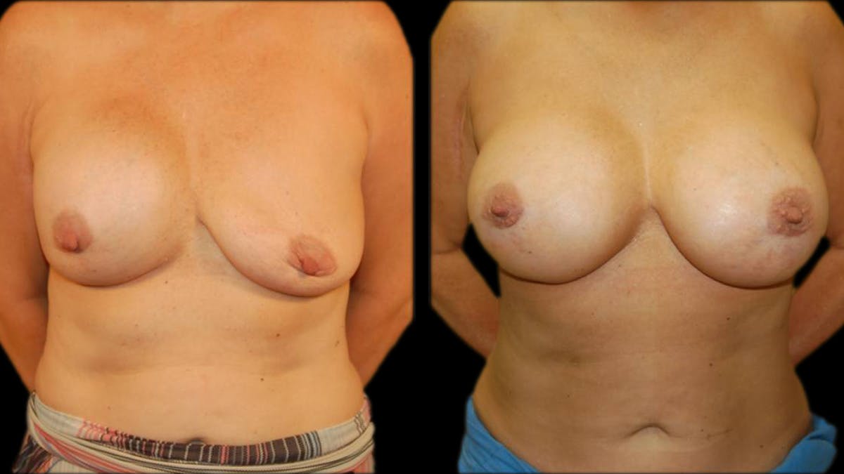 Breast Lift with Implants Before & After Gallery - Patient 413768 - Image 1