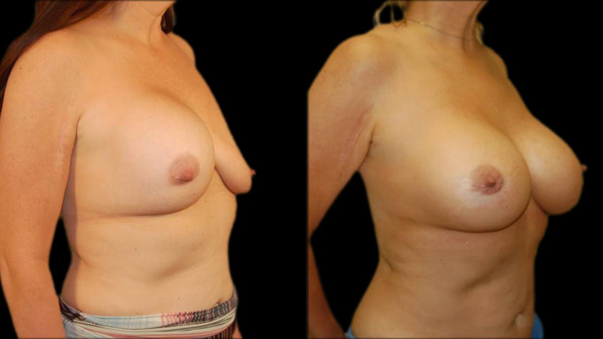 Breast Lift with Implants Before & After Gallery - Patient 413768 - Image 2
