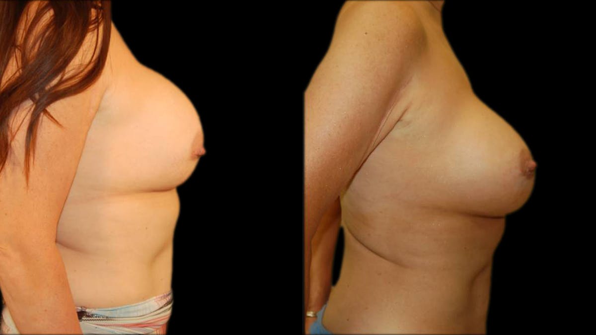 Breast Lift with Implants Before & After Gallery - Patient 413768 - Image 3