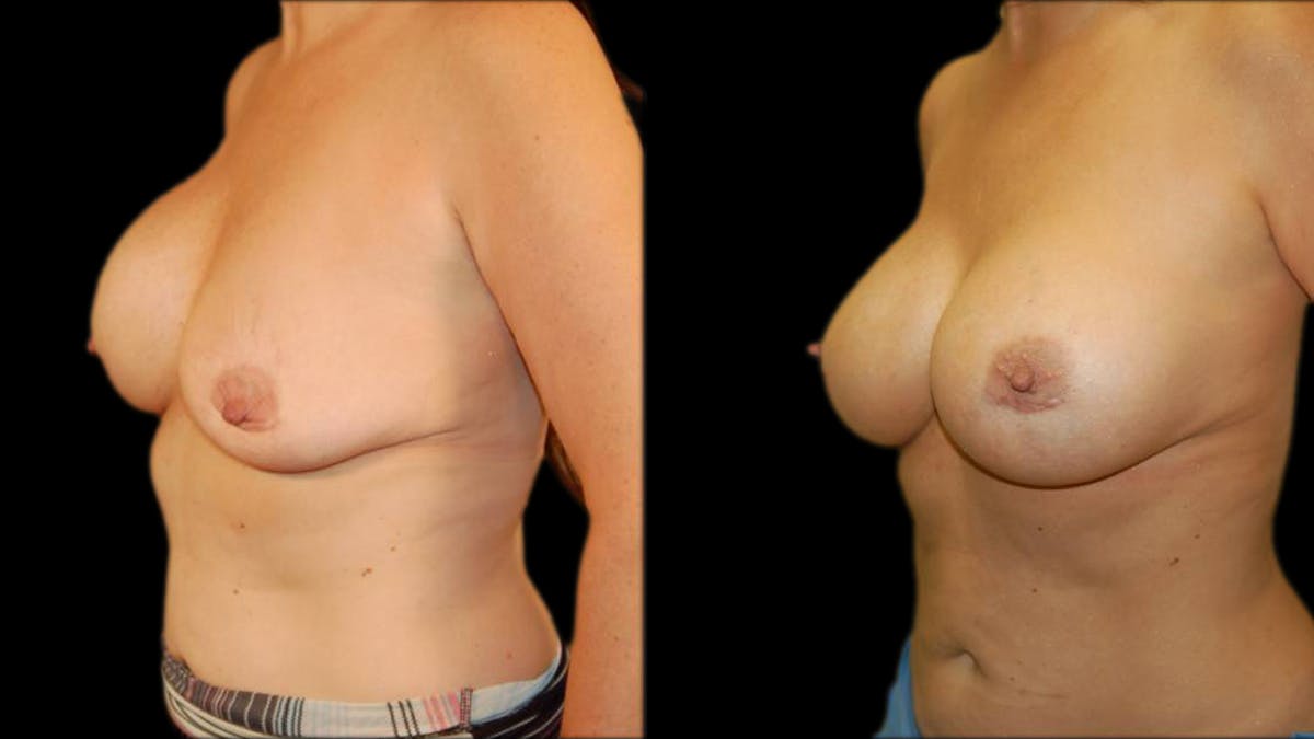 Breast Lift with Implants Before & After Gallery - Patient 413768 - Image 4