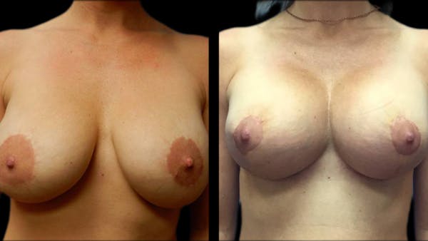 Breast Lift with Implants Before & After Gallery - Patient 574578 - Image 1
