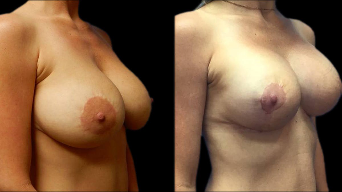Breast Lift with Implants Before & After Gallery - Patient 574578 - Image 2