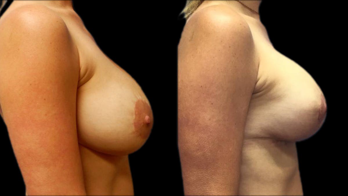 Breast Lift with Implants Before & After Gallery - Patient 574578 - Image 3