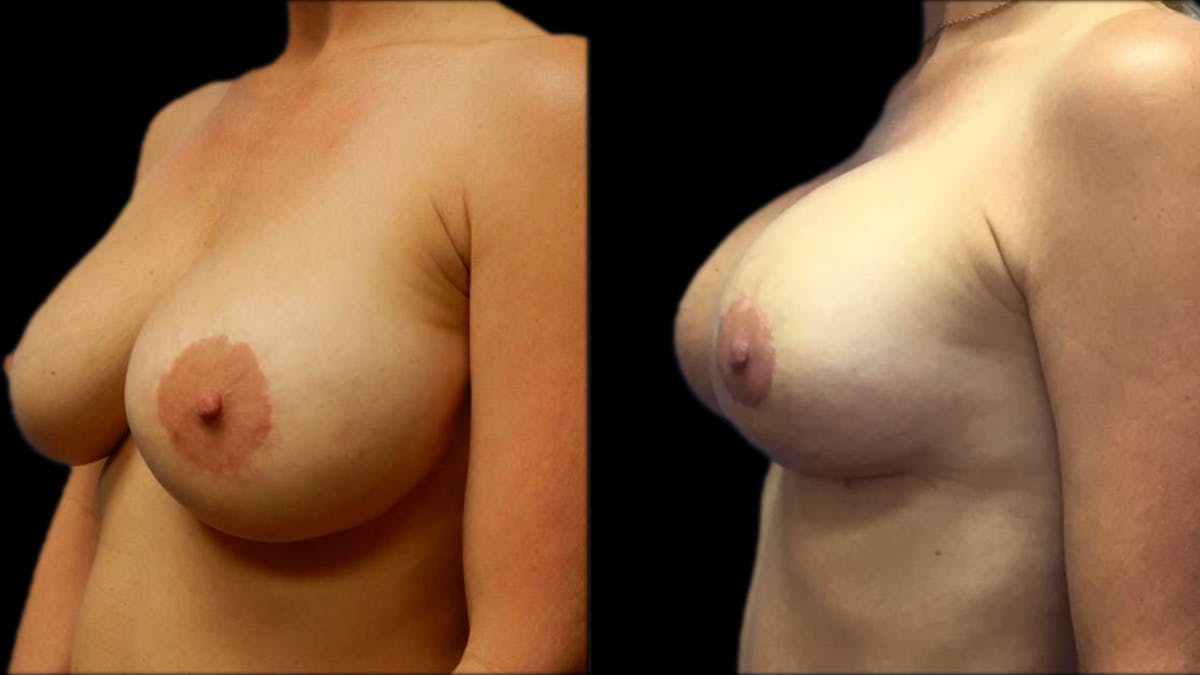 Breast Lift with Implants Before & After Gallery - Patient 574578 - Image 4