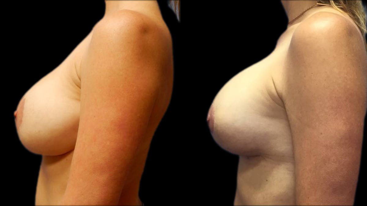 Breast Lift with Implants Before & After Gallery - Patient 574578 - Image 5