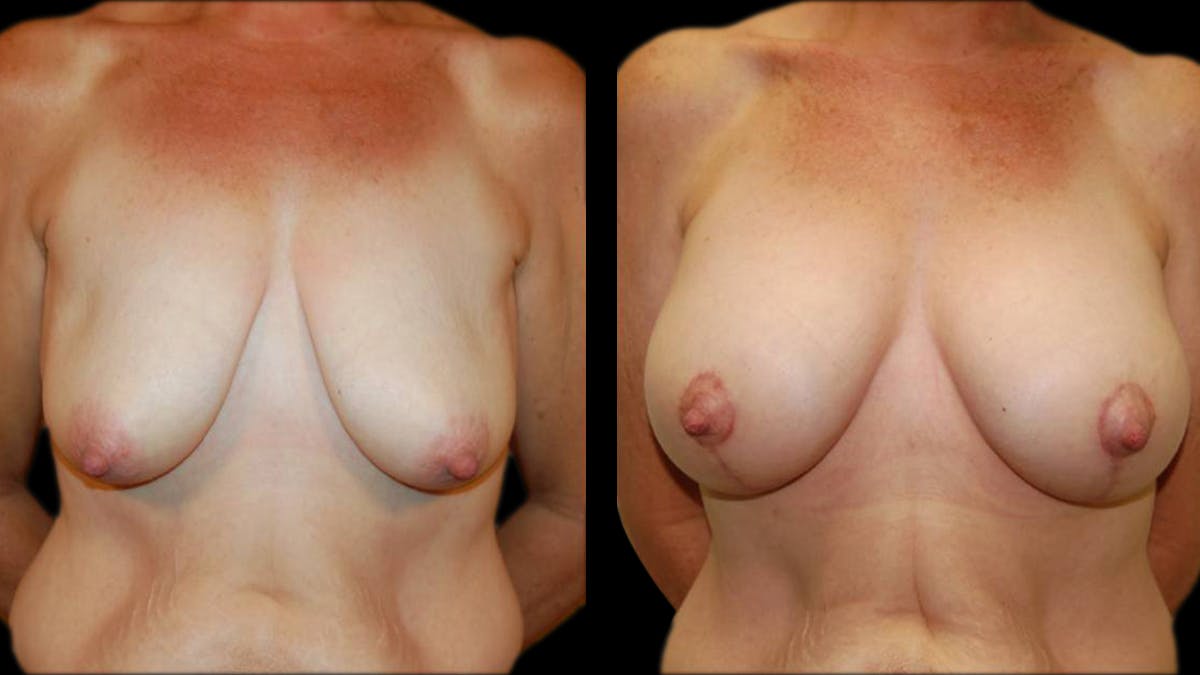 Breast Lift with Implants Before & After Gallery - Patient 402914 - Image 1