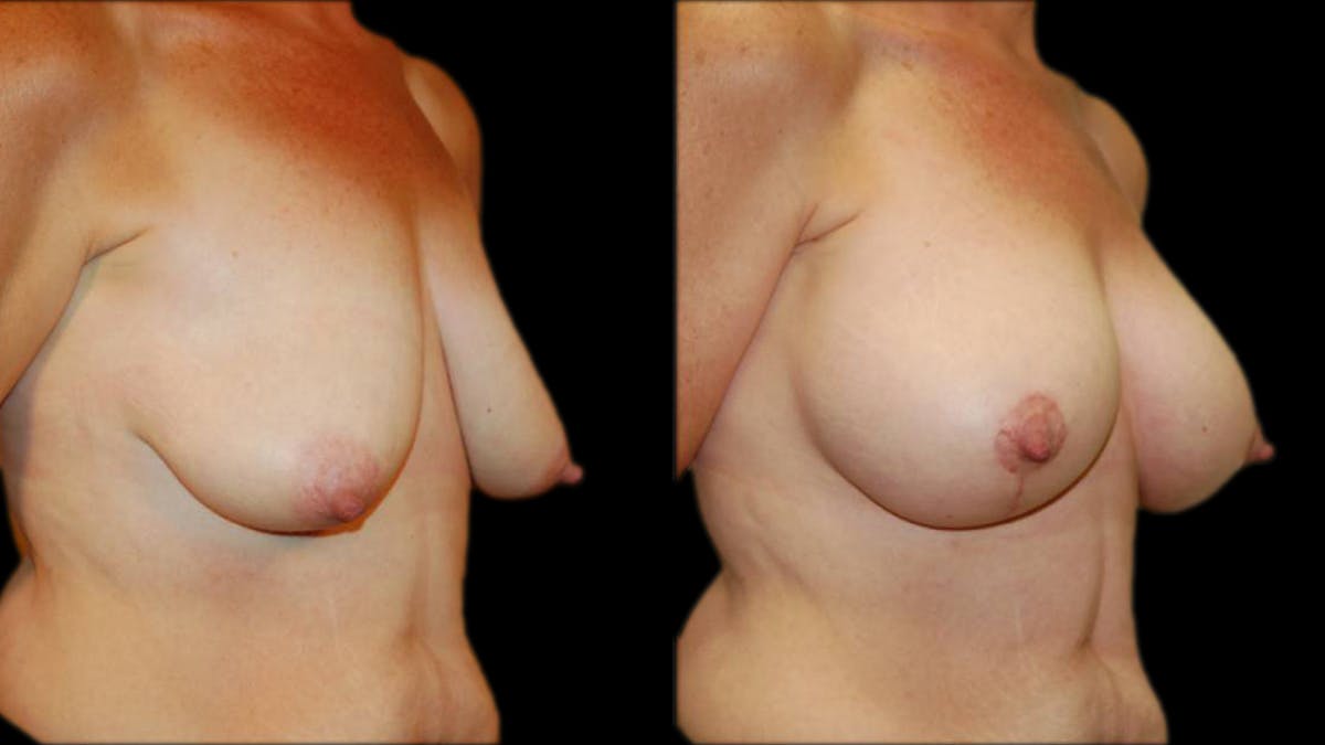 Breast Lift with Implants Before & After Gallery - Patient 402914 - Image 2