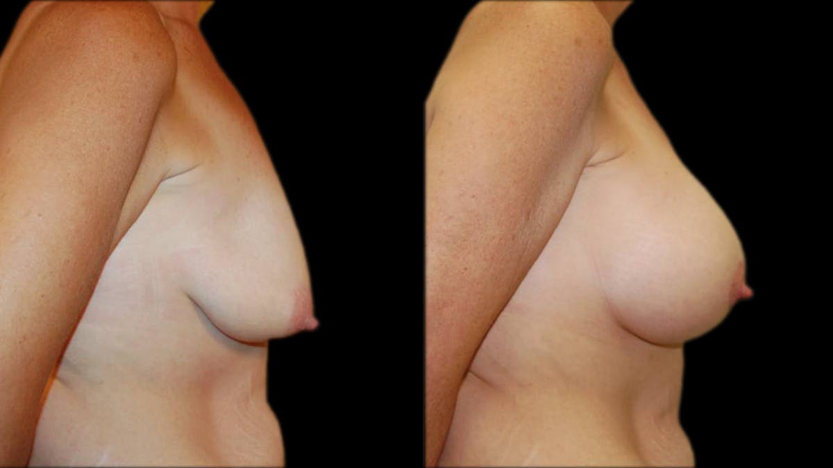 Breast Lift with Implants Before & After Gallery - Patient 402914 - Image 3