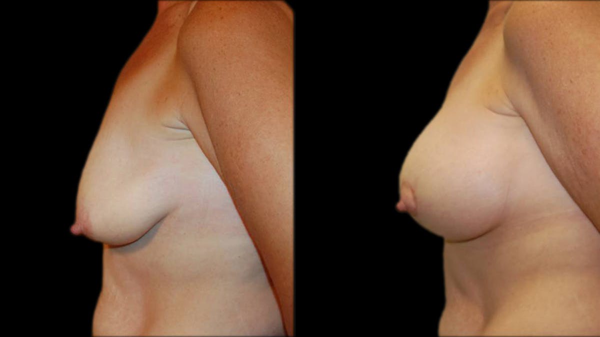 Breast Lift with Implants Before & After Gallery - Patient 402914 - Image 5