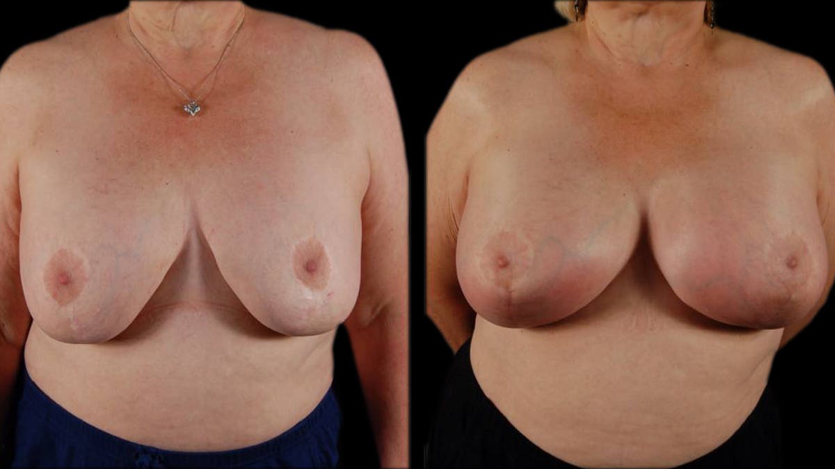 Breast Lift with Implants Before & After Gallery - Patient 733959 - Image 1