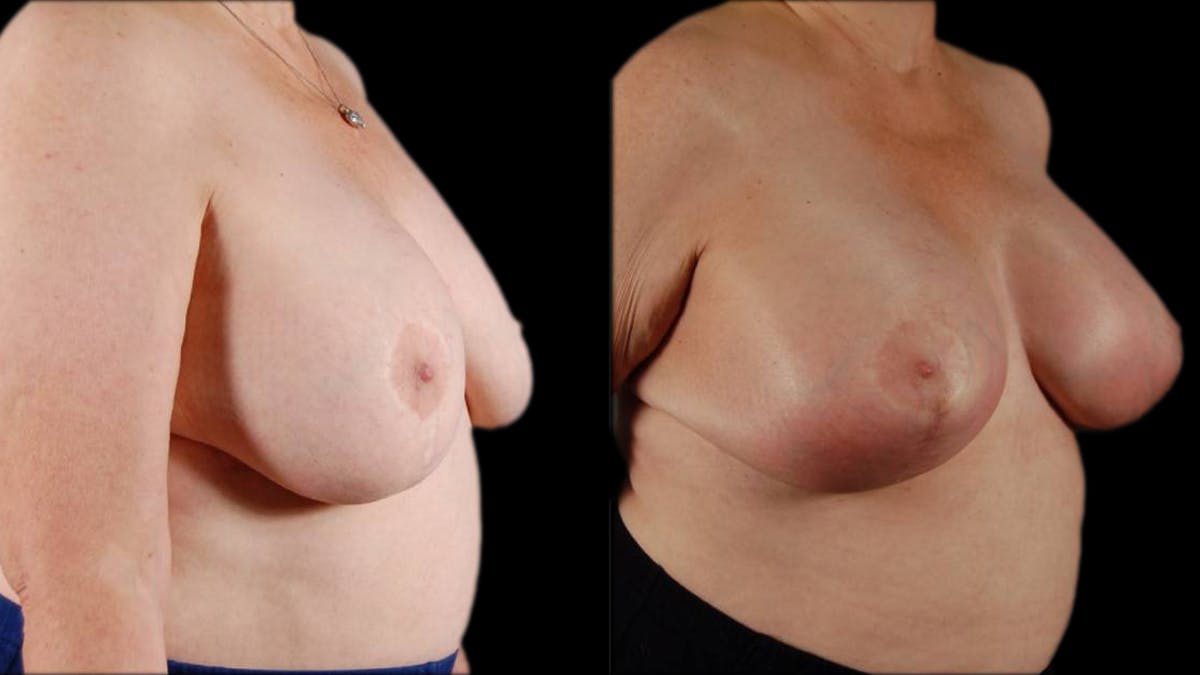 Breast Lift with Implants Before & After Gallery - Patient 733959 - Image 2