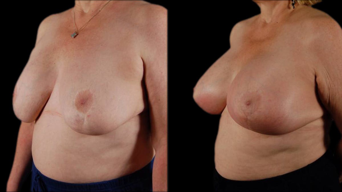 Breast Lift with Implants Before & After Gallery - Patient 733959 - Image 3