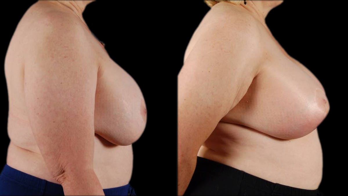Breast Lift with Implants Before & After Gallery - Patient 733959 - Image 4