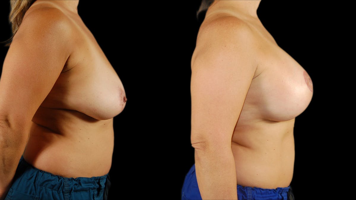 Breast Lift with Implants Before & After Gallery - Patient 211757 - Image 2