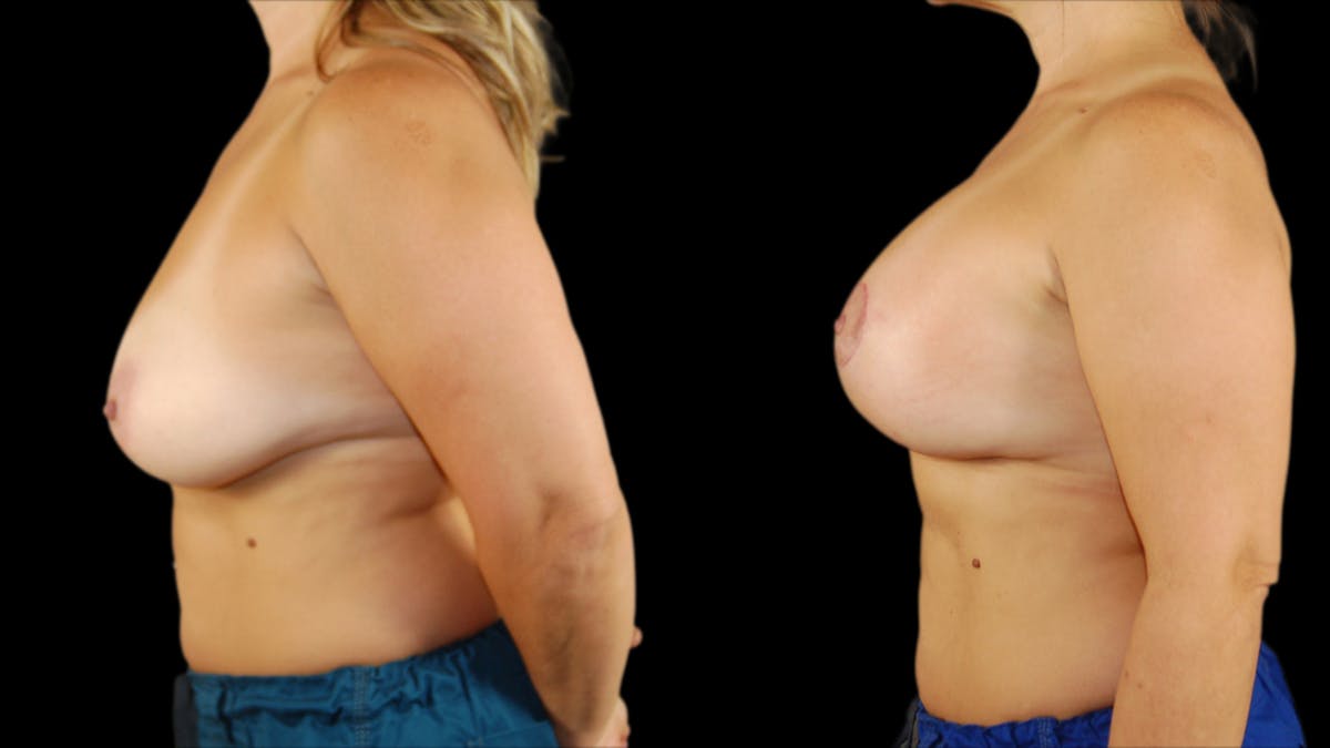 Breast Lift with Implants Before & After Gallery - Patient 211757 - Image 4