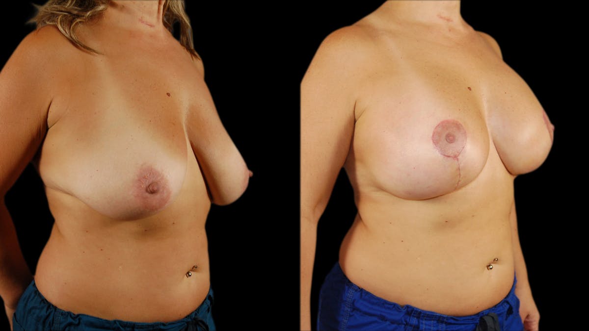 Breast Lift with Implants Before & After Gallery - Patient 211757 - Image 5
