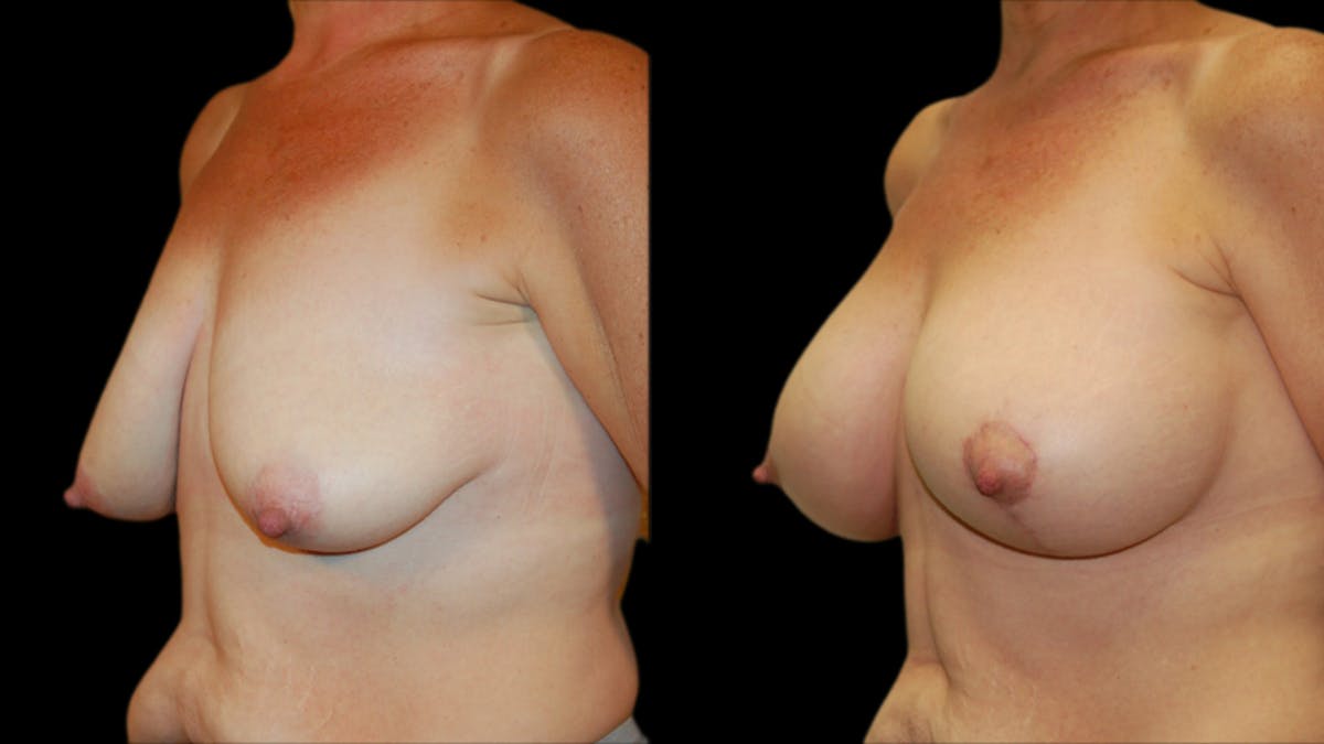 Breast Lift with Implants Before & After Gallery - Patient 596430 - Image 4