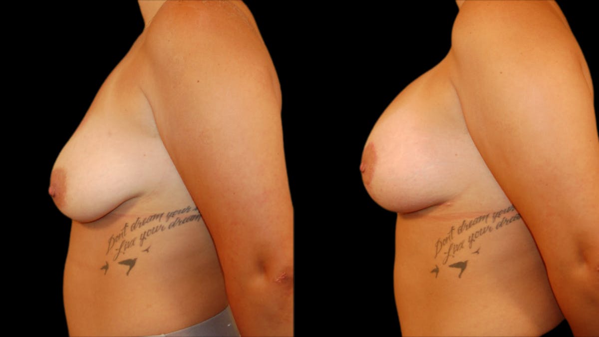 Breast Lift with Implants Before & After Gallery - Patient 280910 - Image 3