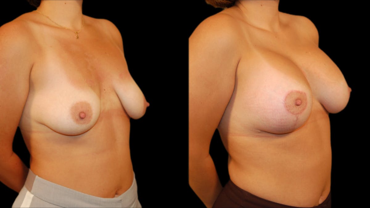 Breast Lift with Implants Before & After Gallery - Patient 280910 - Image 4