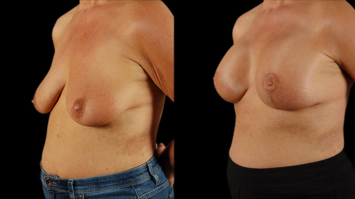 Breast Lift with Implants Before & After Gallery - Patient 364709 - Image 2