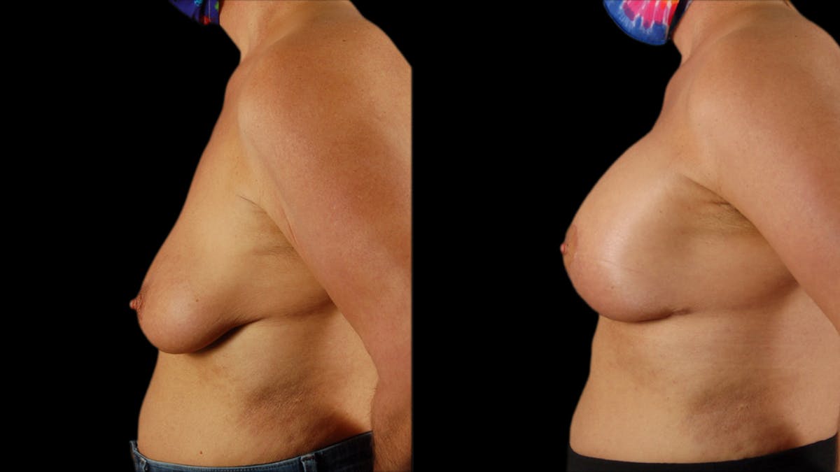 Breast Lift with Implants Before & After Gallery - Patient 364709 - Image 3