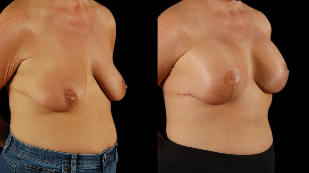 Breast Lift with Implants Before & After Gallery - Patient 364709 - Image 4