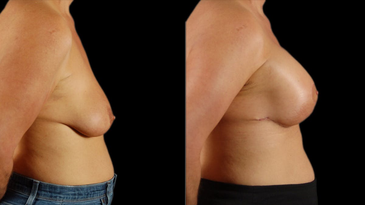 Breast Lift with Implants Before & After Gallery - Patient 364709 - Image 5