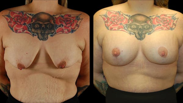 Breast Lift with Implants Before & After Gallery - Patient 245881 - Image 1
