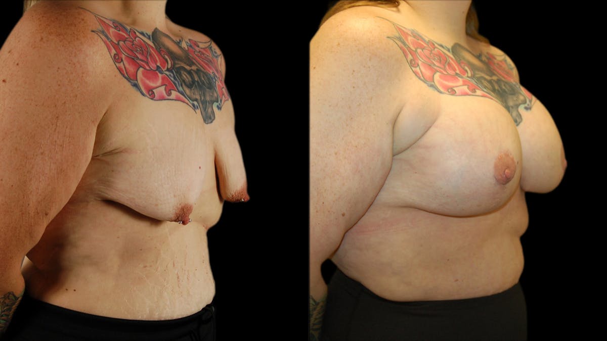 Breast Lift with Implants Before & After Gallery - Patient 245881 - Image 2