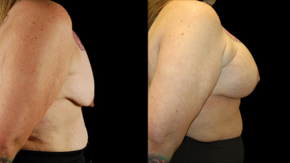 Breast Lift with Implants Before & After Gallery - Patient 245881 - Image 3