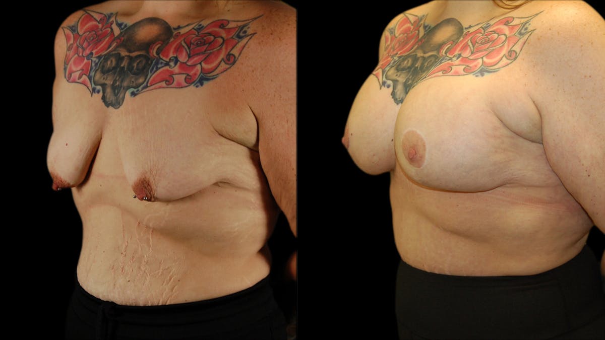 Breast Lift with Implants Before & After Gallery - Patient 245881 - Image 4