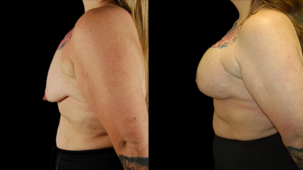 Breast Lift with Implants Before & After Gallery - Patient 245881 - Image 5