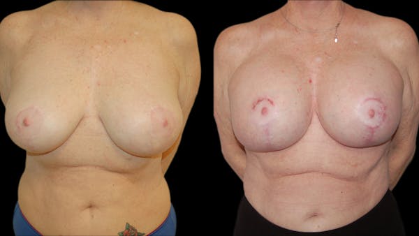 Breast Lift with Implants Before & After Gallery - Patient 290688 - Image 1