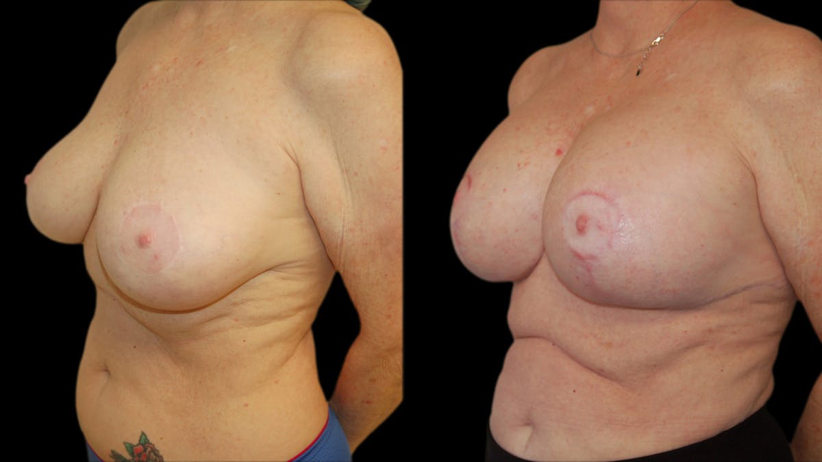 Breast Lift with Implants Before & After Gallery - Patient 290688 - Image 2