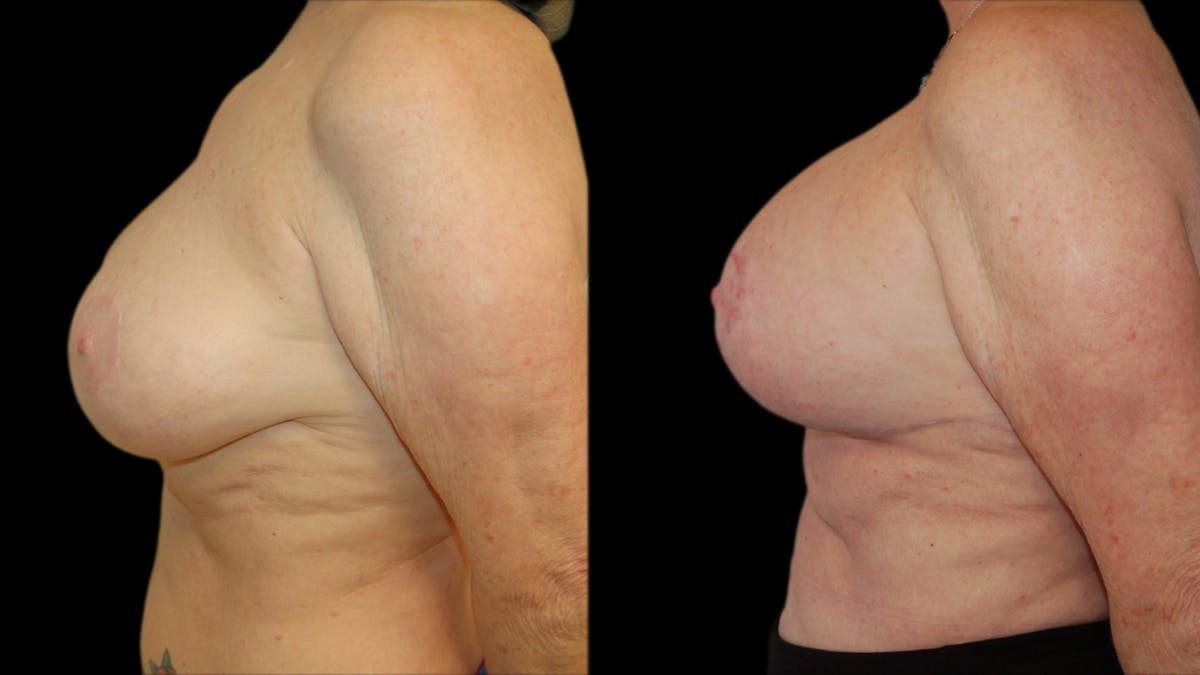 Breast Lift with Implants Before & After Gallery - Patient 290688 - Image 3