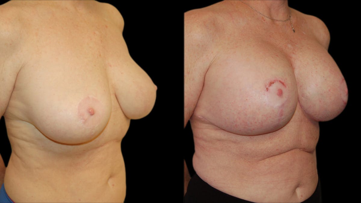 Breast Lift with Implants Before & After Gallery - Patient 290688 - Image 4