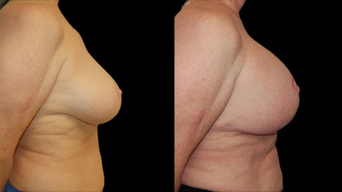 Breast Lift with Implants Before & After Gallery - Patient 290688 - Image 5