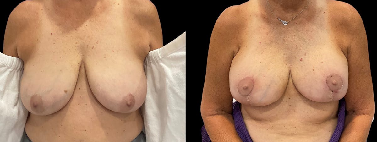 Breast Reconstruction Before & After Gallery - Patient 186954 - Image 1