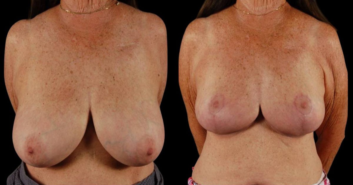 Breast Reduction Before & After Gallery - Patient 255984 - Image 1