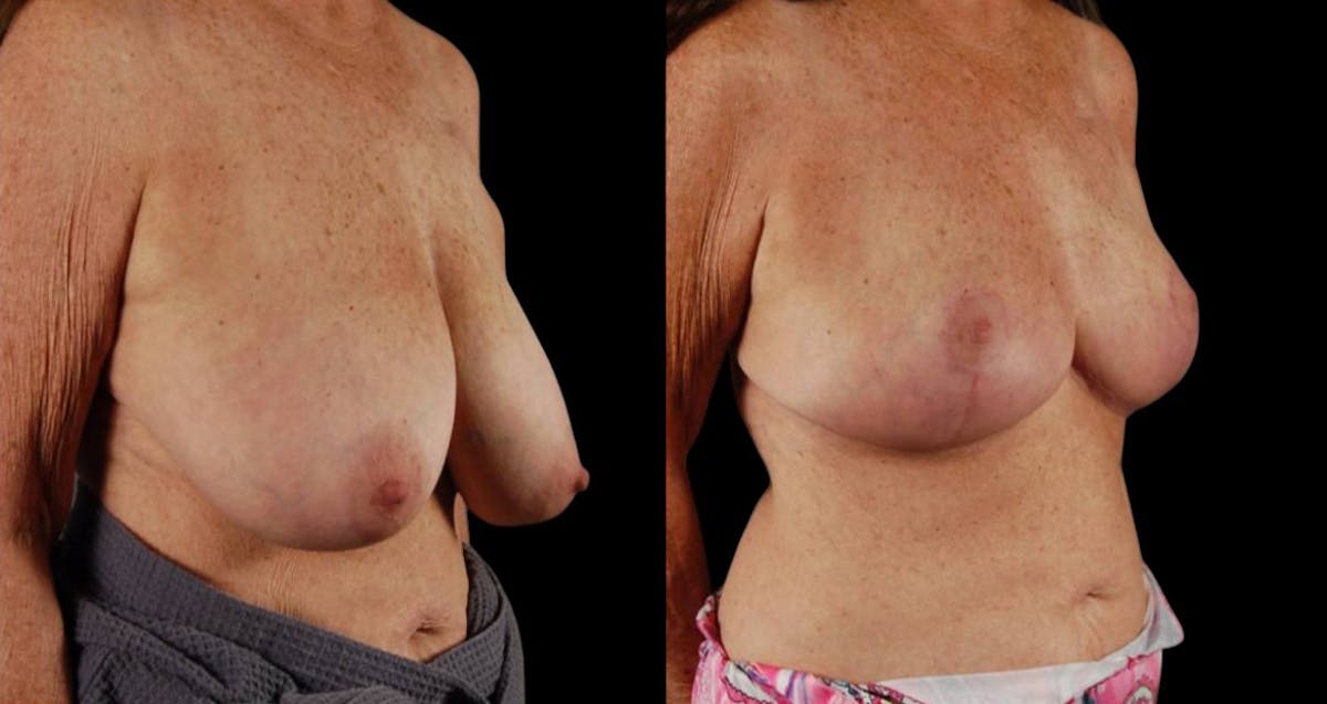 Breast Reduction Before & After Gallery - Patient 255984 - Image 2